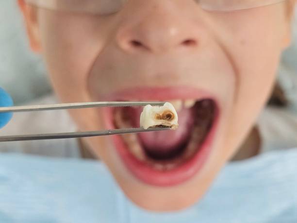 Best Emergency Wisdom Teeth Removal in Lutz, FL